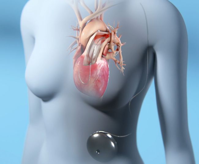 Aria CV device for treating pulmonary arterial hypertension
