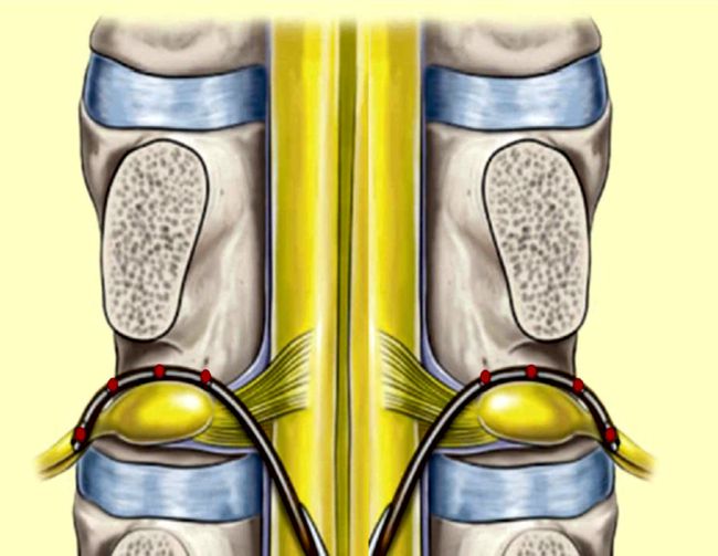 From Pawel et al., "Electrical Diuretics: Dorsal Root Ganglion Stimulation to Increase Diuresis,"Neuromodulation: Technology at the Neural Interface,
Volume 27, Issue 7,
2024, Pages 1208-1217