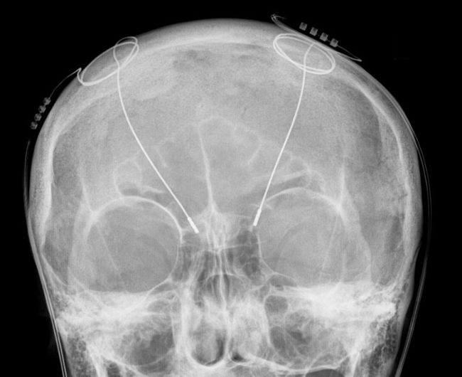 DBS electrodes in skull